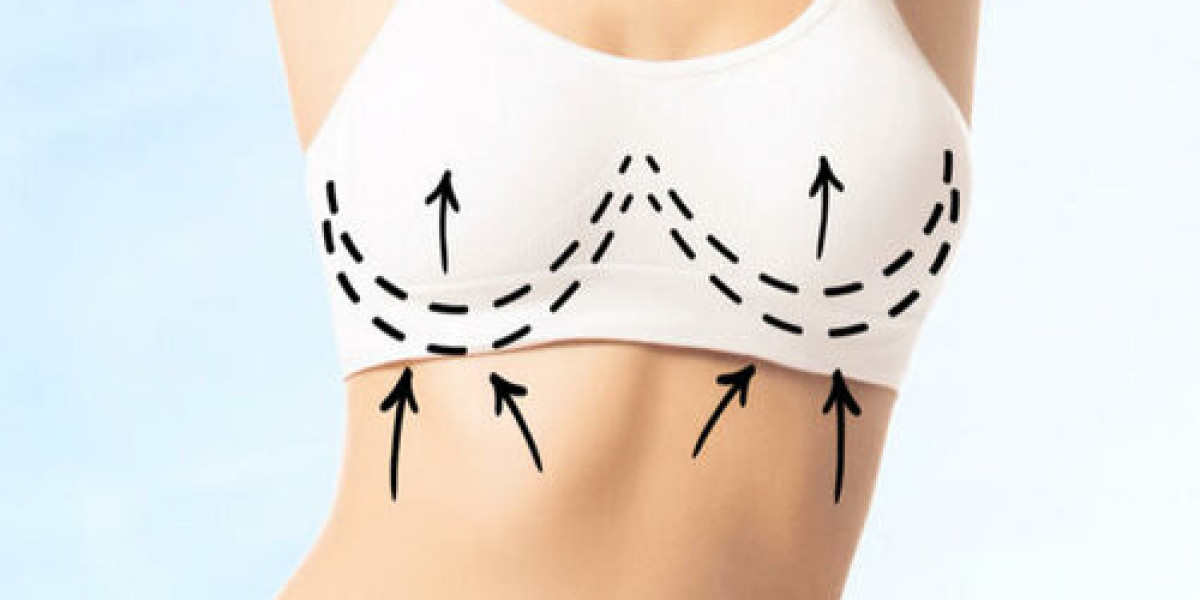 Breast Lift Chicago for a Youthful, Natural Contour