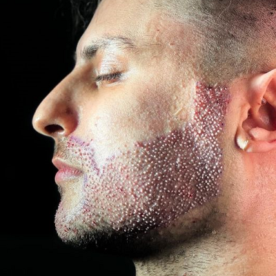 Beard Hair Transplant in Islamabad, Pakistan - HTP