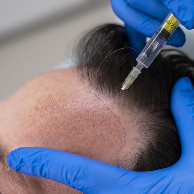 Exosomes For Hair Loss in Islamabad, Pakistan